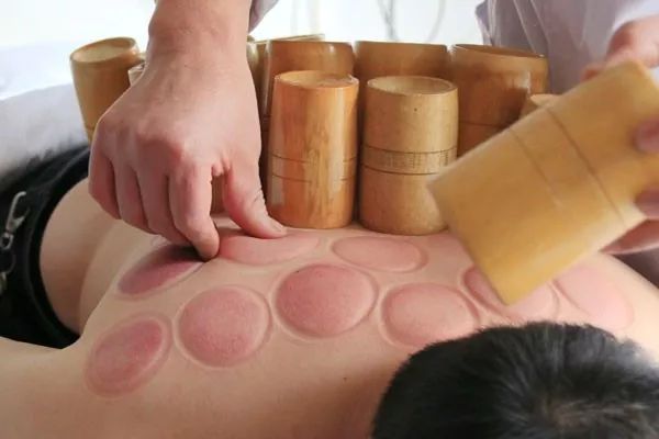 提醒：拔罐结束，四件事最好别做！别拿健康开玩笑