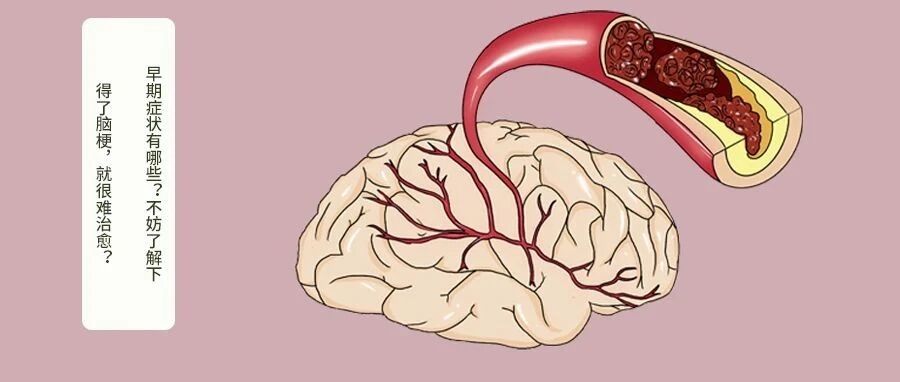 得了脑梗，就很难治愈？早期症状有哪些？不妨了解下