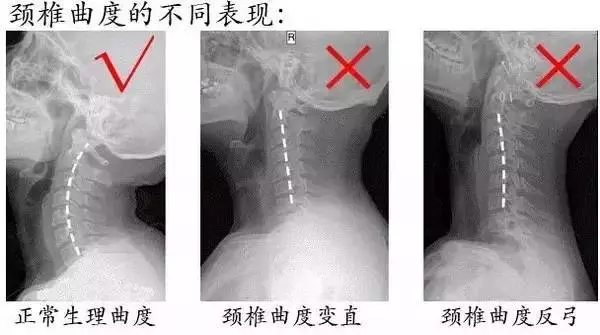 頸椎咔咔響,手腳發麻要注意 頸椎咔咔響,手腳發麻要注意