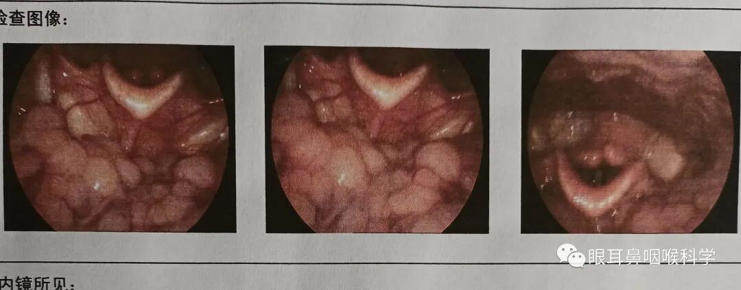 耳鼻喉内镜是什么科耳鼻喉科中的“万能眼”！_https://www.jmylbn.com_新闻资讯_第4张