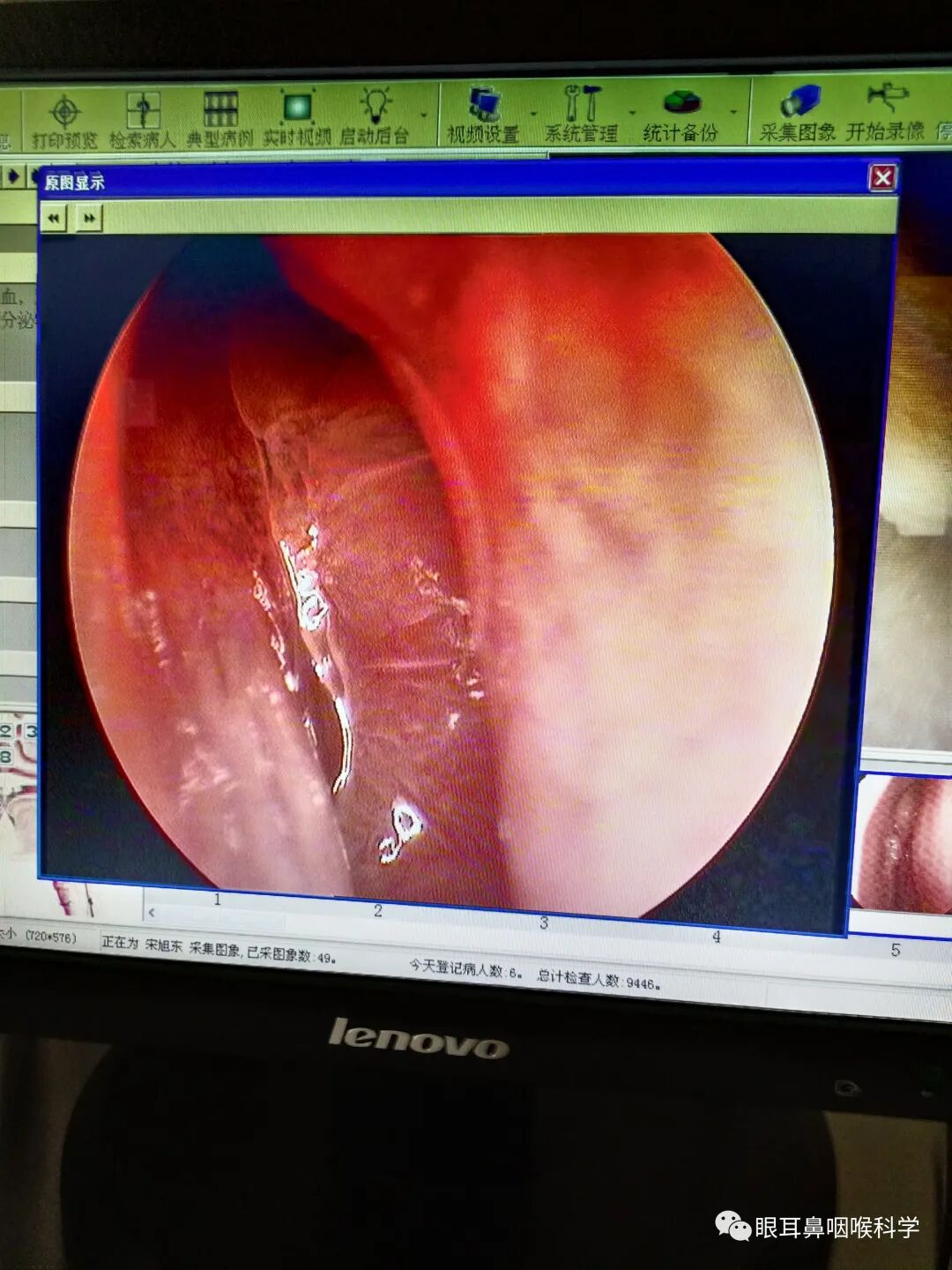 耳鼻喉内镜是什么科耳鼻喉科中的“万能眼”！_https://www.jmylbn.com_新闻资讯_第2张
