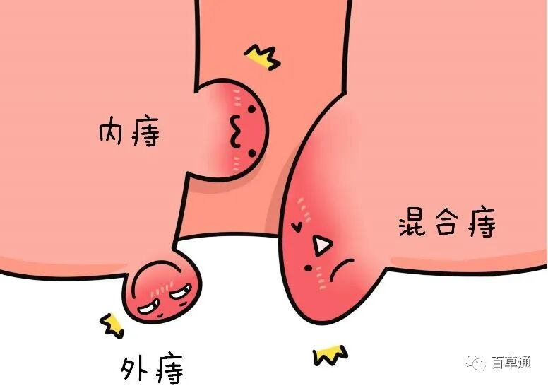 痔疮用的消炎药有什么副作用吗(痔疮消炎药有哪些口服)