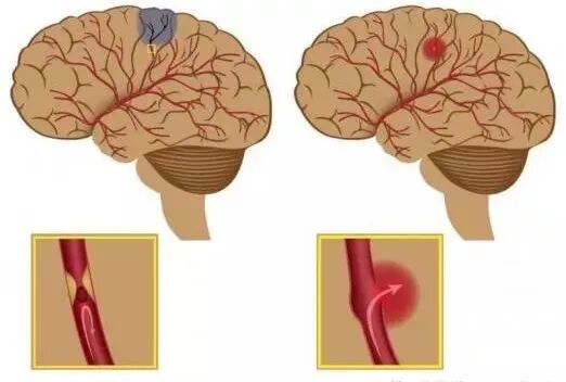 天基权治疗仪怎么样天基权科普｜中国脑健康日，关愛脑健康，健康才是真正的“头”等大事!_https://www.jmylbn.com_新闻资讯_第2张