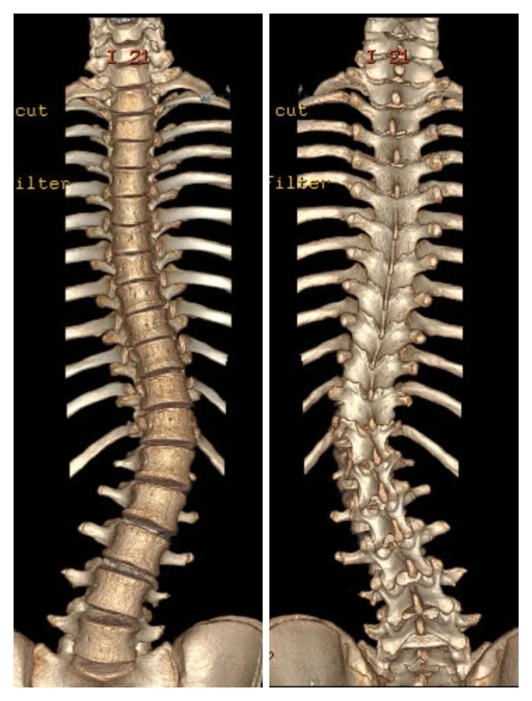 健康促进关注青少年特发性脊柱侧弯让青春挺直腰杆自信逐梦
