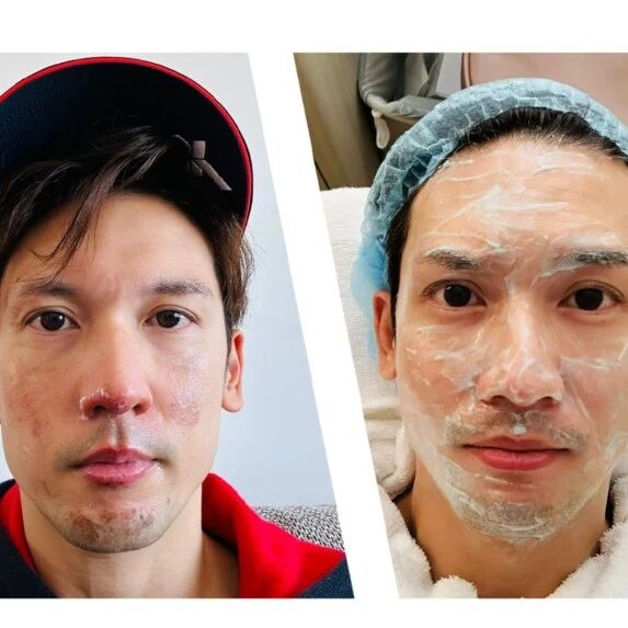 关智斌面部手部二级烧伤!