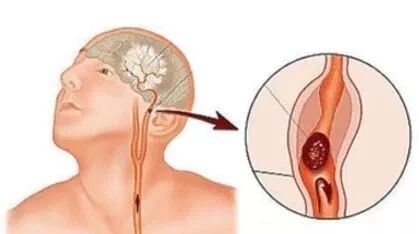 再谈颈动脉斑块
