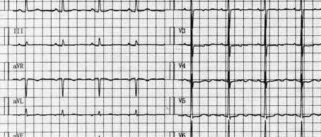 “心慌”是心脏病吗？