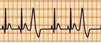 大白话说说心脏早搏