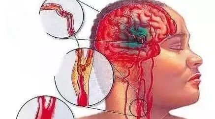 什么是颈动脉斑块？有何危害？如何处理？