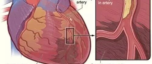 【中国心梗救治日】时间就是心肌，时间就是生命，赶快拨打120！