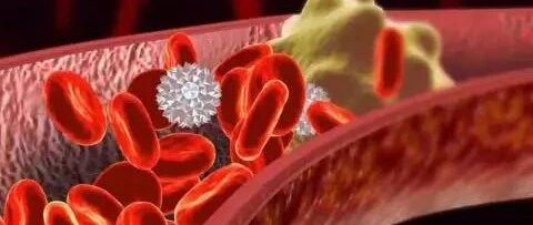 高血压引起心梗只需这几步……