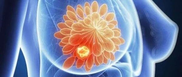 胸大的女生，更容易得乳腺癌吗？