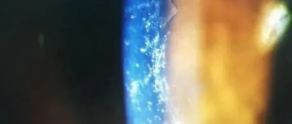 28岁女生熬夜刷手机，突发视力模糊！照镜子一看被吓坏，“眼睛下雪”险失明！