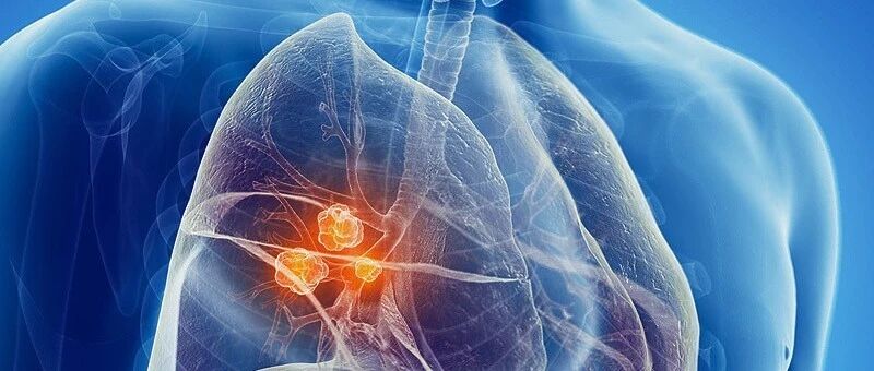 很多女性患肺癌却无抽烟习惯！忽视这1条件恐怕连命都没了...