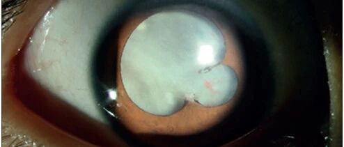 一种被全球忽视的眼病，落在这名8岁男孩身上，他只能勉强看清手指......