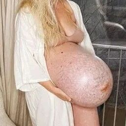 怀孕9月肚子竟向前凸！尺寸超巨像冬瓜...网惊：像要爆炸了！