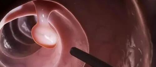 46岁男子6毫米的小息肉，短短3年变成肠癌！