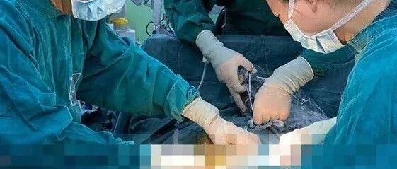 杯具！啤酒玻璃杯深入直肠6cm卡死　他肚子剧痛...医生急开刀救命！