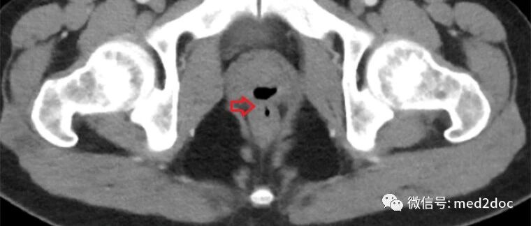 33岁男子罹患罕见怪病：肛门射精、阴茎排便，研究发现竟是......