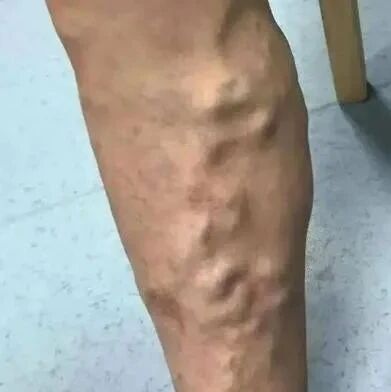 宁波男子烧着菜，突然喷血到休克！这病不少人都有！这些动作，赶紧停！