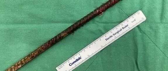 30cm钢筋插入眼部贯穿大脑,但他奇迹般被救活！这样的医学奇迹和经典,胆小的就不要看了！