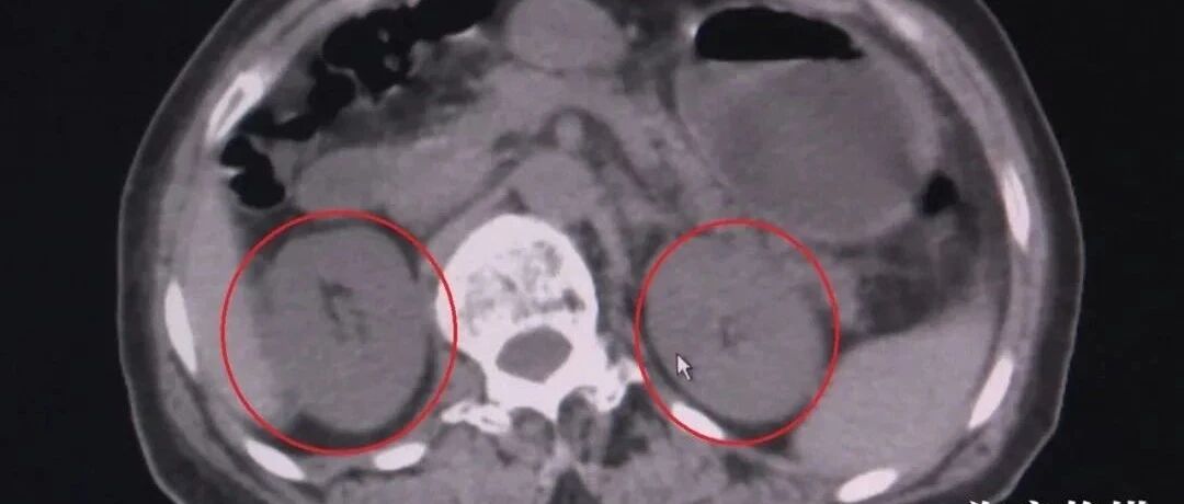吃了一盘家常菜 ，​63岁妇女3天不排尿，还患上尿毒症！很多人都爱吃