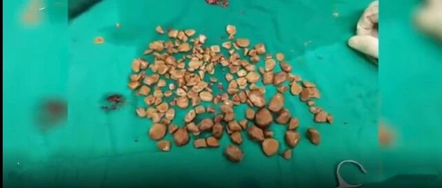 密密麻麻！膀胱里竟取出200颗......都是这些坏习惯惹的祸！男性更危险，千万别做这些事