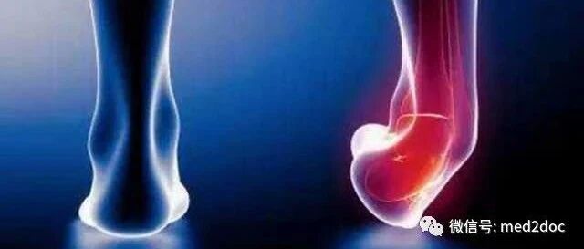 年轻姑娘崴脚12天后离世！她忽视的问题你可能每天都在犯