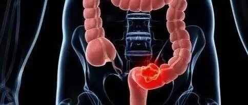 ​又一个名人因癌症去世，年仅54岁！查出肠癌已属晚期！