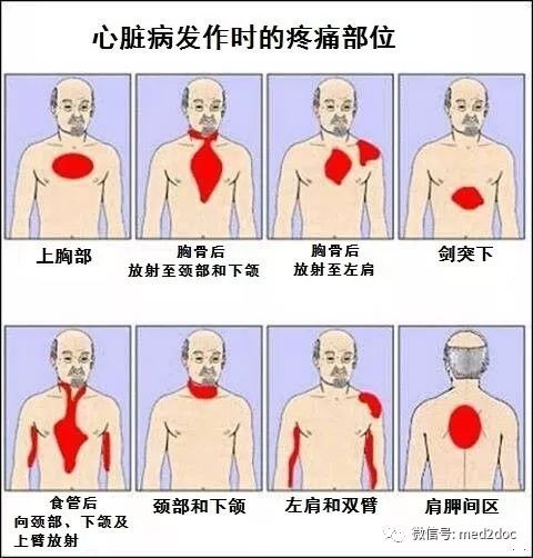 沒有胸痛的心梗，對醫生來說猶如夢魘一般！ 健康 第3張