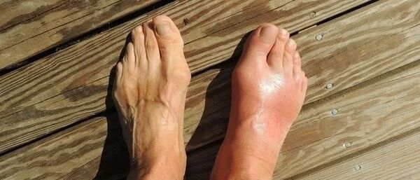 47岁男子尿酸高，吃完火锅后却突然昏迷！别以为高尿酸只因会导致痛风！