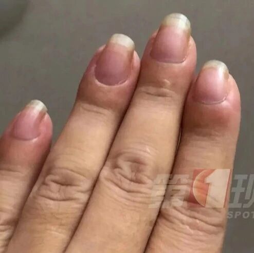 女子手指奇怪变化，一查竟是肺癌！警惕身体这3种信号→