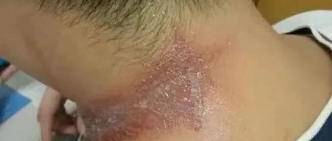 近期高发！湖南多人被毒伤，长沙有医院7天接诊百余例！医生提醒…...