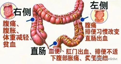 24歲姑娘自以為懷孕，沒想到竟是結腸癌晚期！到底該如何遠離大腸癌? 健康 第2張