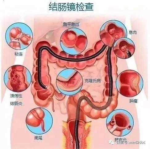 24歲姑娘自以為懷孕，沒想到竟是結腸癌晚期！到底該如何遠離大腸癌? 健康 第3張