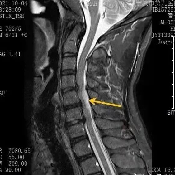 上班族脖子痛没在意…2小时后全身瘫痪！医生称，平常这些举动很危险！