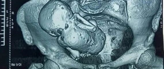 别样“石头记”！73岁老妇突发肚子痛去医院检查，竟发现......网友不淡定了！