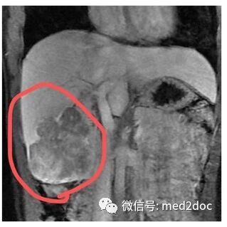 长期熬夜+三餐外卖+烧烤宵夜，22岁女生查出巨大肝癌……