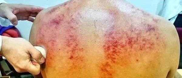 48岁男子头颈疼痛半个月，自家刮痧一半心脏骤停！一查竟是......