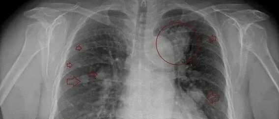 咳嗽1年吃成药！她咳出血丝罹肺癌晚期…崩溃：我都不抽烟