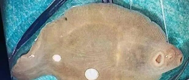 一女子肝脏被吃掉三分之一！找到“凶手”，医生连呼太罕见！