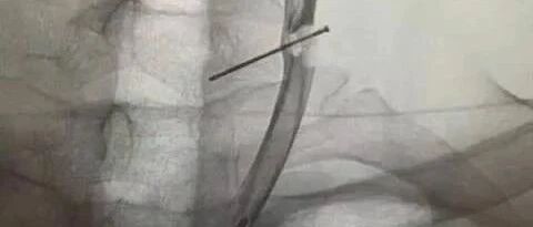 男子突然头晕，医生惊呆！3厘米铁钉在脖子扎了10年都没感觉？