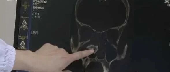 70多岁老人鼻子突然流“血涕” ！元凶竟是一块“石头”