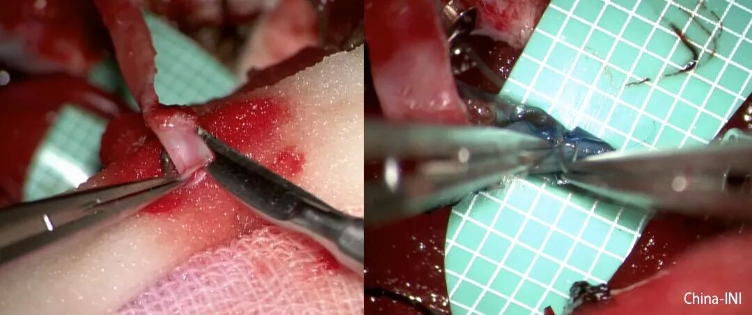 宣武神外dias精致学手术系列之002枕动脉小脑后小动脉