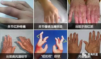 什么是mtc治疗改善类风湿关节炎，早期规范治疗是关键！-上海聚慕医疗器械有限公司