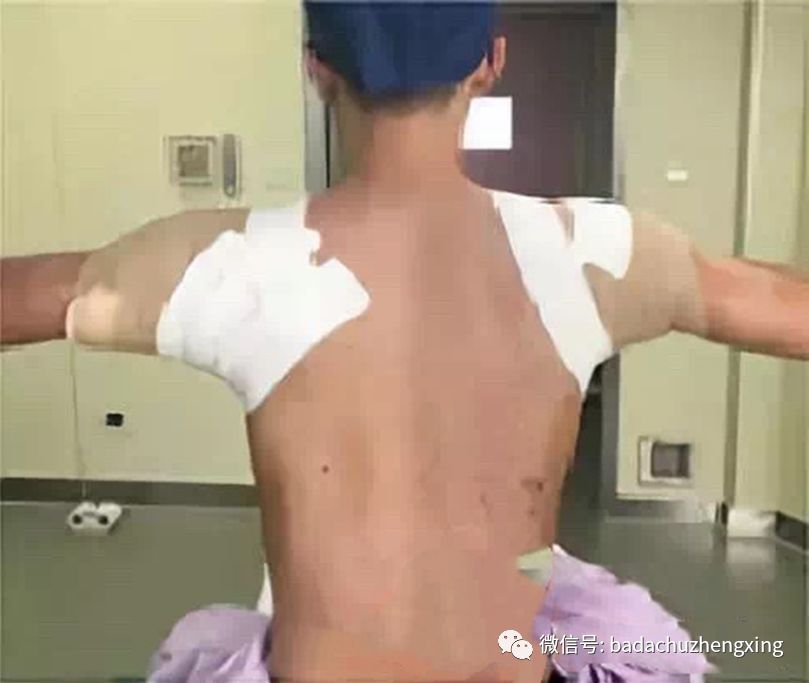 微波治疗机怎么使用天气热了，尴尬的腋臭多汗症_https://www.jmylbn.com_新闻资讯_第7张