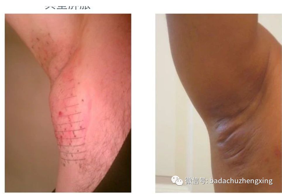 微波治疗机怎么使用天气热了，尴尬的腋臭多汗症_https://www.jmylbn.com_新闻资讯_第17张