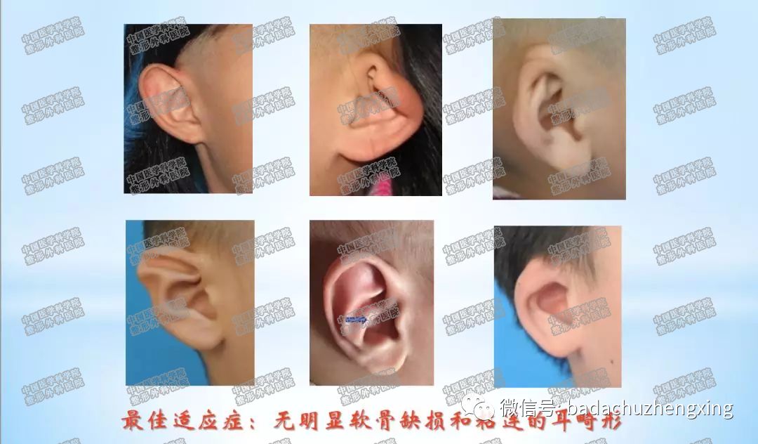 小儿耳廓畸形矫治