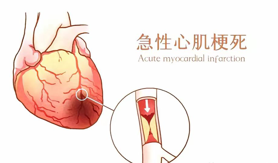 中国心梗救治日 ｜ 心梗拨打120胸痛中心快救命