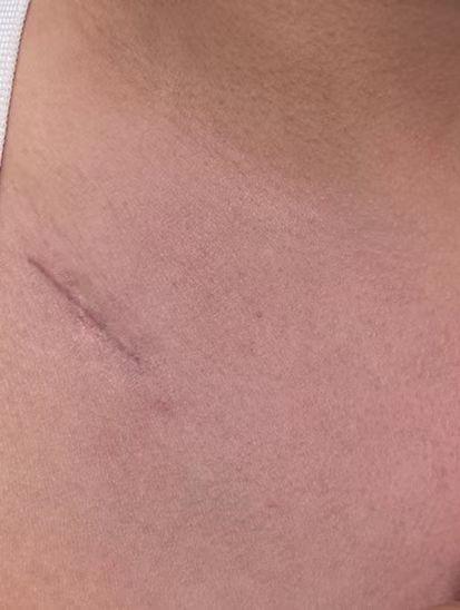 外科拉勾怎么拉突破！我院头颈外科经锁骨下入路腔镜甲状腺手术成熟，自主设计拉钩获国家级实用新型专利！_https://www.jmylbn.com_新闻资讯_第6张